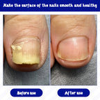 Fungal Nail Treatment,21PCS Toe Nail Fungal Treatment Patch